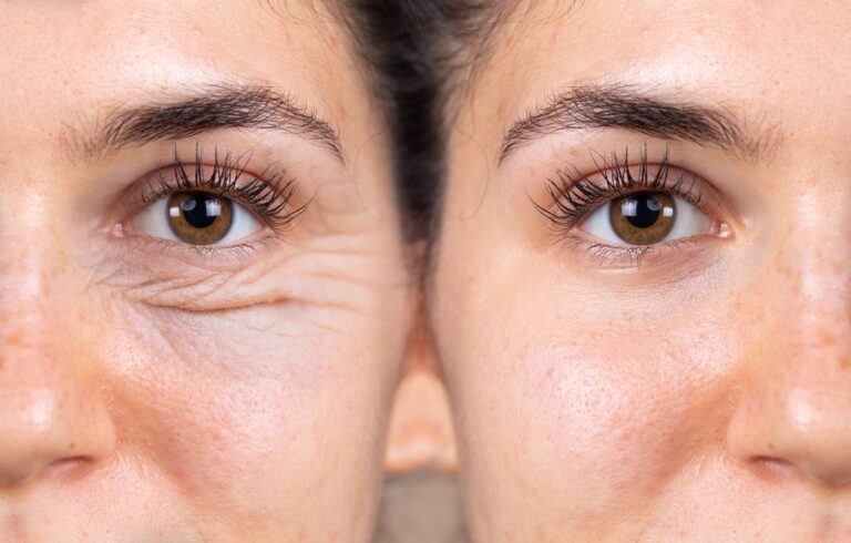 blépharoplastie, est une intervention de chirurgie esthétique du visag