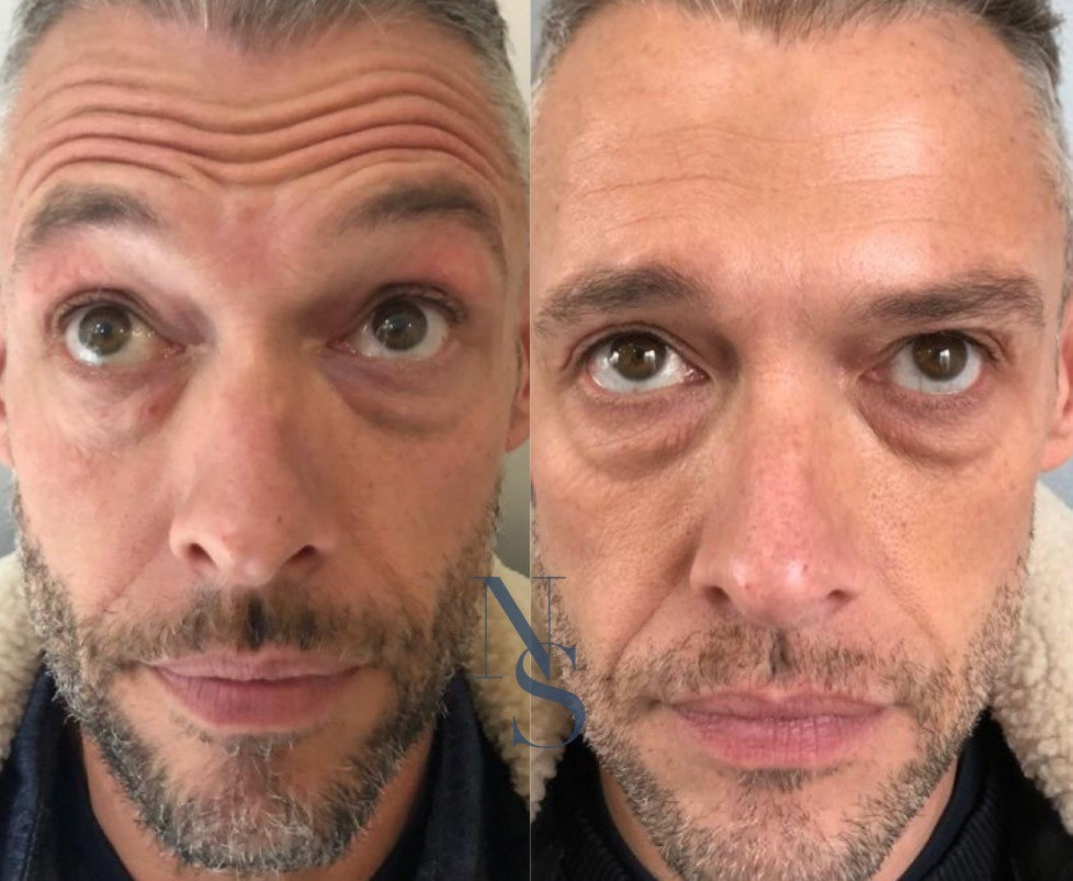 Traitement Botox du visage à Paris