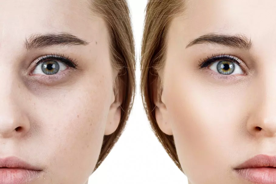 La chirurgie des paupières s’adresse aux femmes et aux hommes présenta