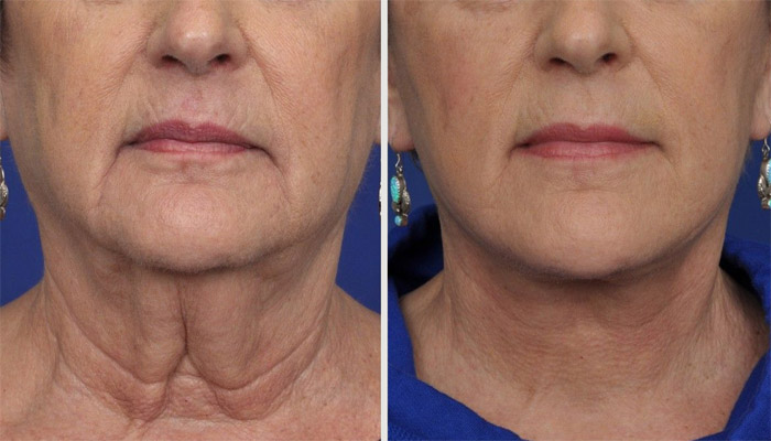 Zones traitées par le lifting du cou