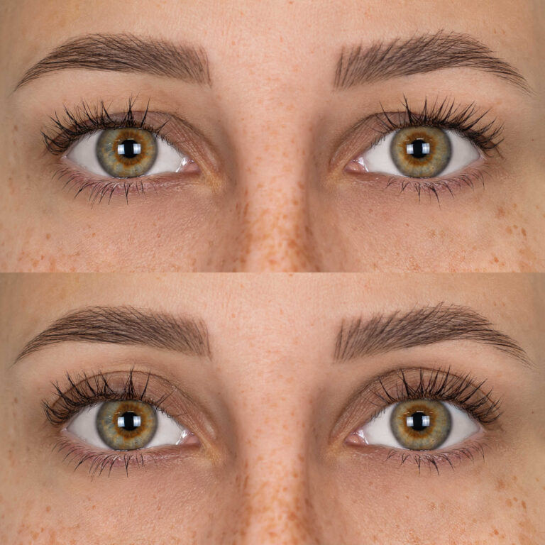 Le lifting des paupières est une technique de chirurgie esthétique du visage visant à corriger la chute des paupières liée au vieillissement.